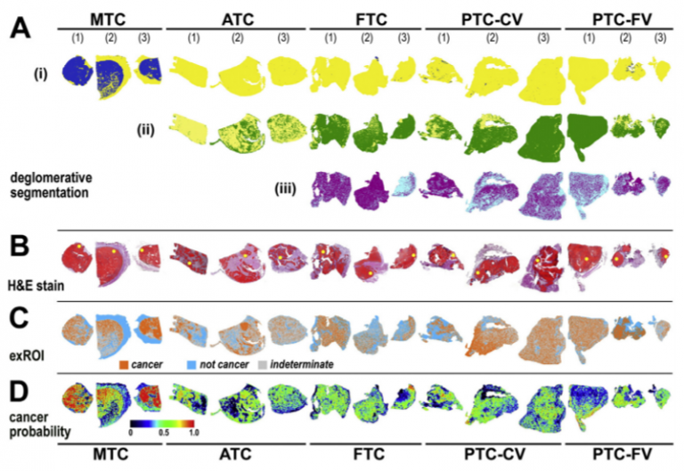 Molecular profiles of thyroid cancer subtypes Classification based on